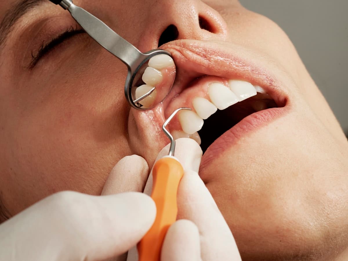 Bone grafting procedure for dental implant site preparation